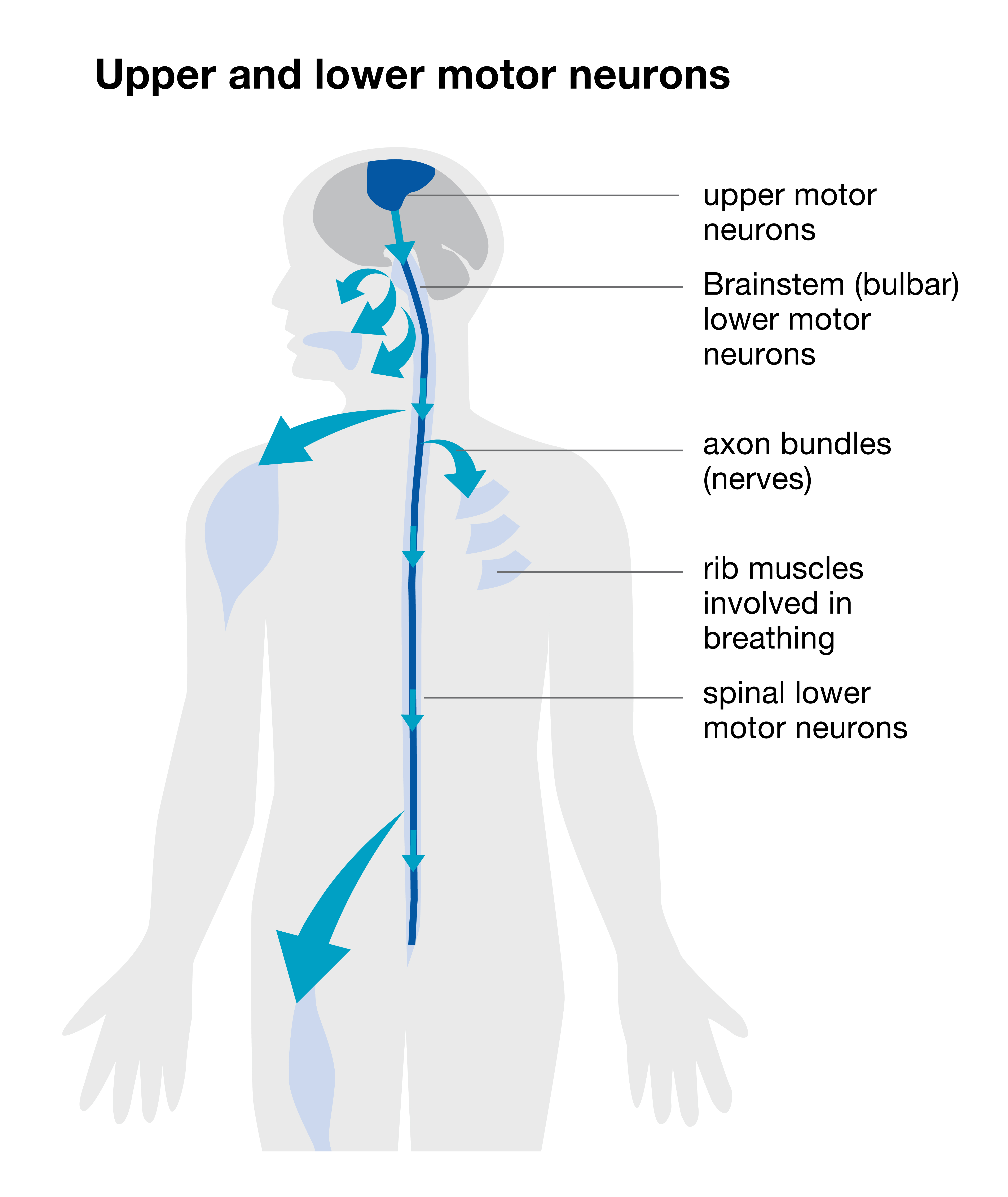 Upper-and-lower-motor-neurones-in-MND.jpg